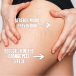 stretch mark prevention